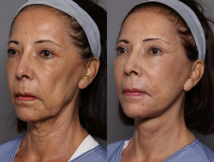 Facelift and Upper Eyelid Lift, Left Oblique Before and After at 3 Months by Kent V. Hasen, MD