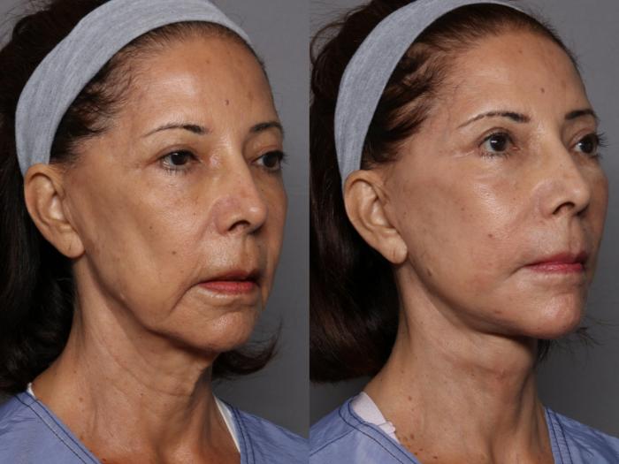 Facelift and Upper Eyelid Lift, Right Oblique View, Before and After at 3 Months by Kent V. Hasen, MD