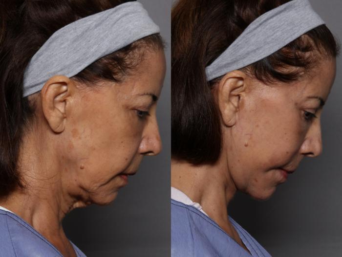 Facelift and Upper Eyelid Lift, Right Side View, Before and After at 3 Months by Kent V. Hasen, MD