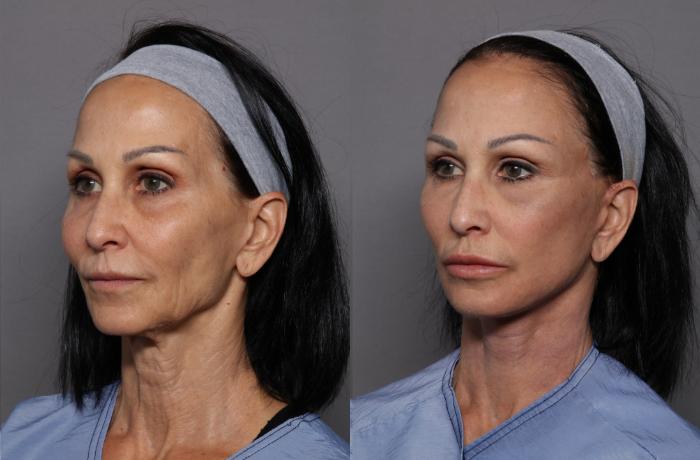 Before & After Facelift Case 439 Left Side View in Naples and Ft. Myers, FL