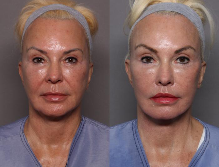 Before & After Upper Lip Lift Case 449 Front View in Naples and Ft. Myers, FL