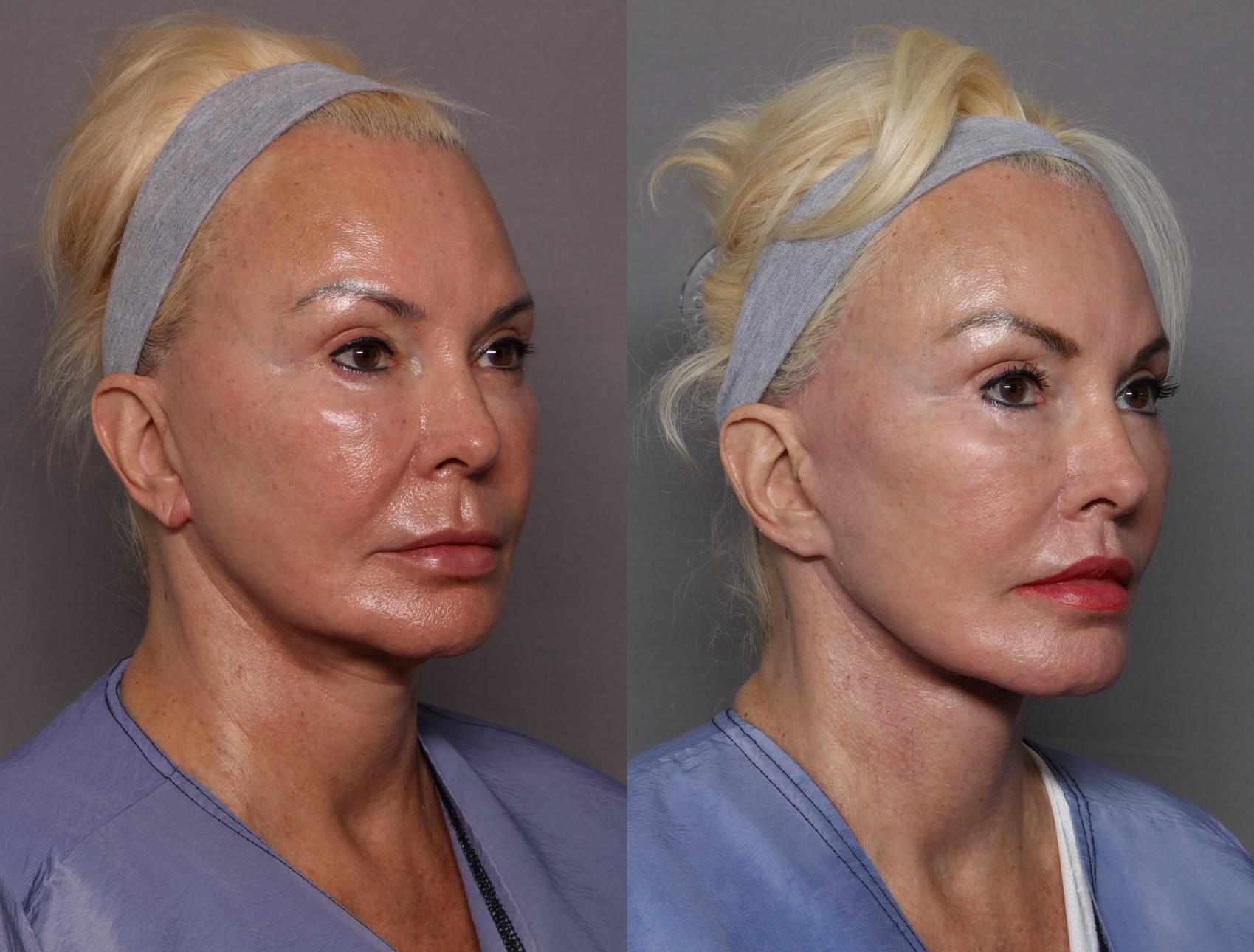Before & After Facelift Case 449 Left Side View in Naples and Ft. Myers, FL
