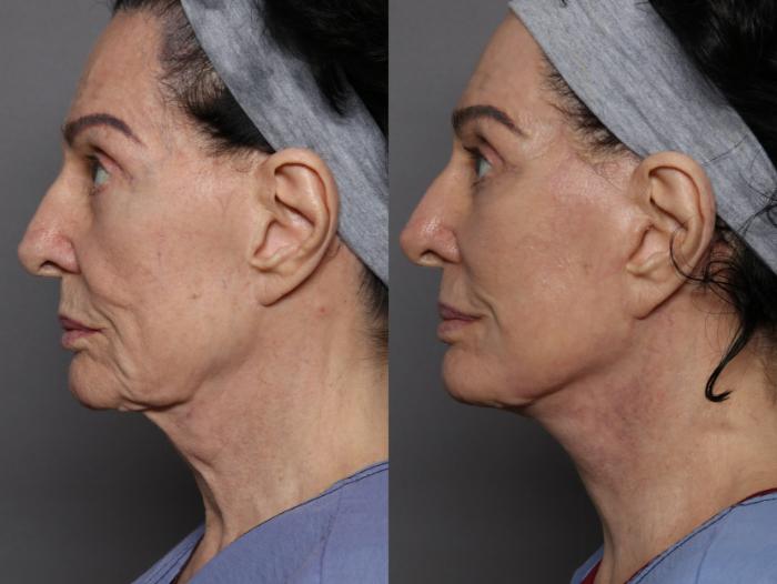 Left Side View, Pre-op Deep Plane Facelift with Sciton Contour TRL Laser Resurfacing