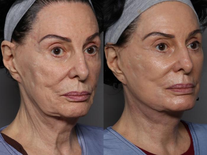 Right Oblique View, Pre-op Deep Plane Facelift with Sciton Contour TRL Laser Resurfacing