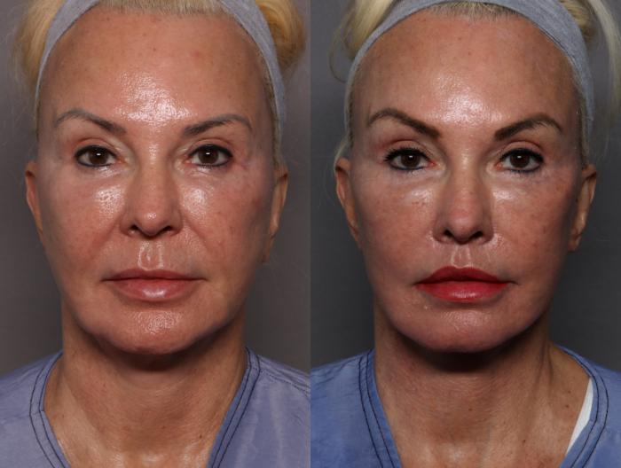 Before Deep Plane Facelift, Brow and Lip Lift, Front View