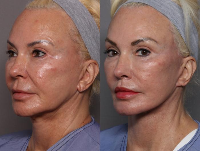 Before Deep Plane Facelift, Brow and Lip Lift, Left Oblique