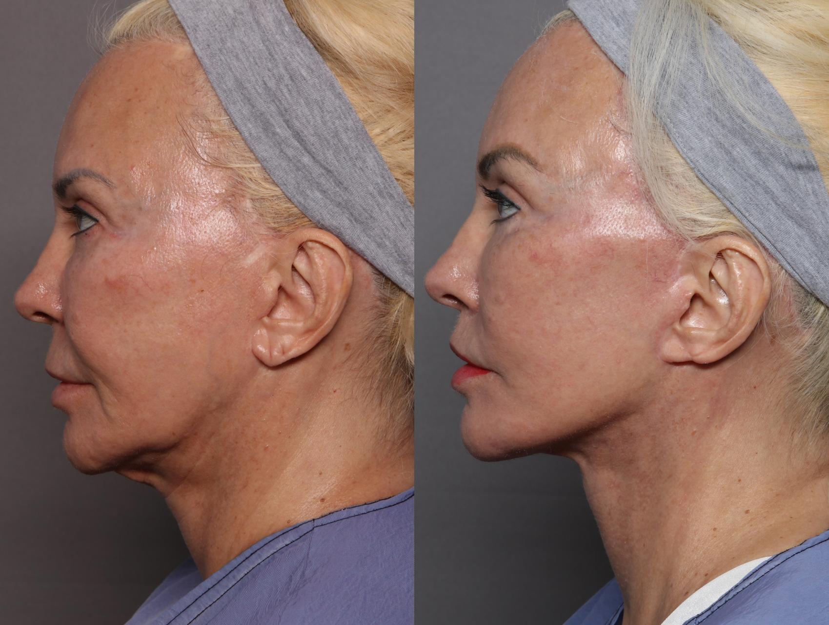 Before Face, Brow and Upper Lip Lift, Left Side View