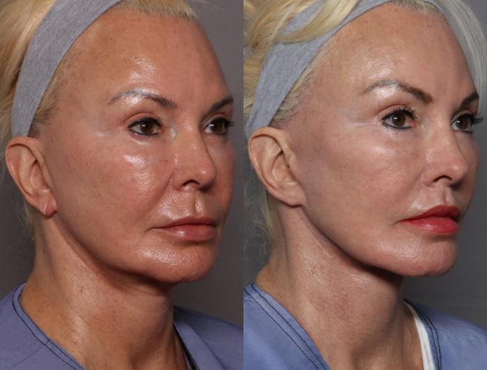 Before Deep Plane Facelift, Brow and Lip Lift, Right Oblique