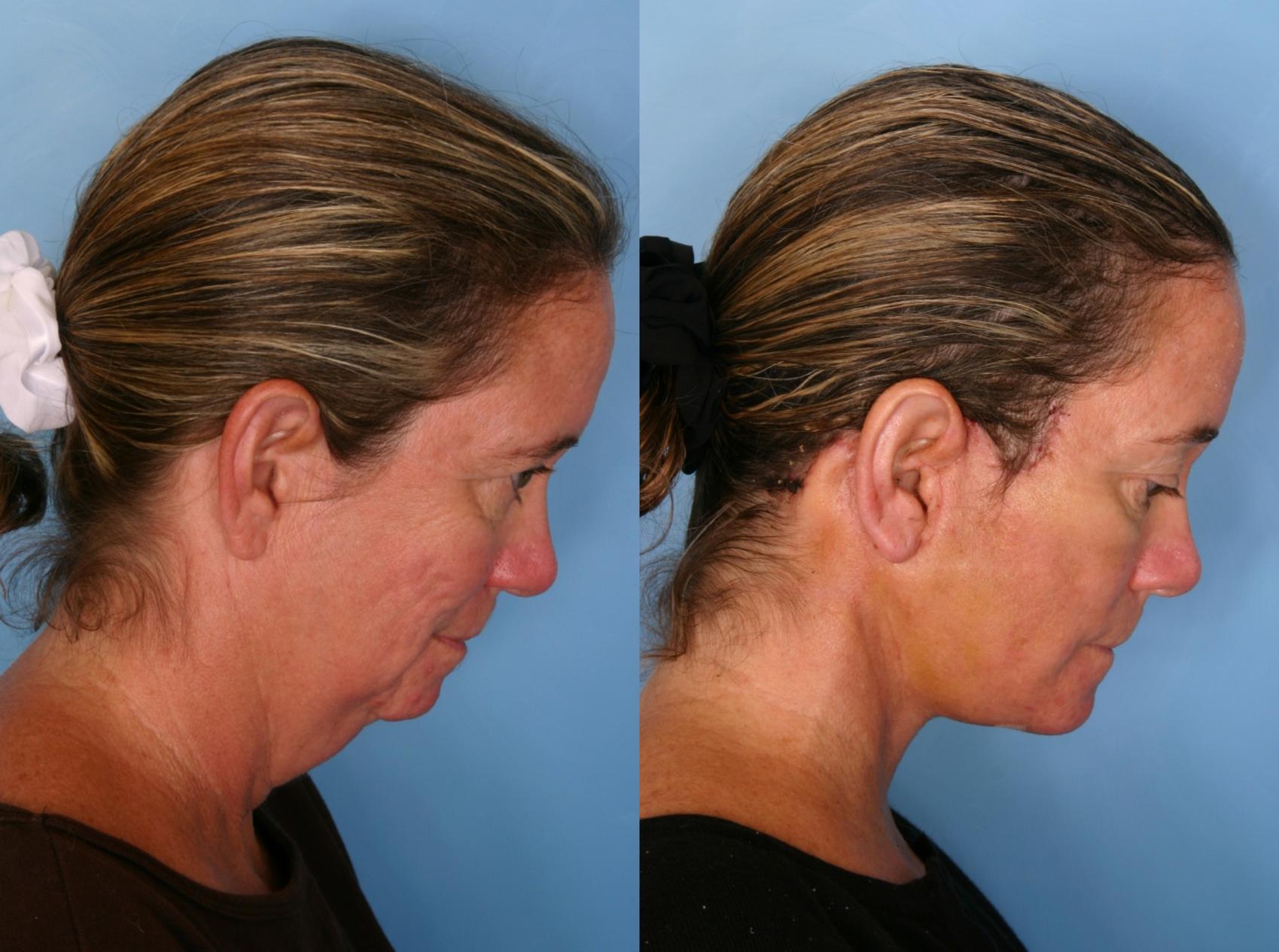 Before & After Facelift Case 66 View #1 View in Naples, FL