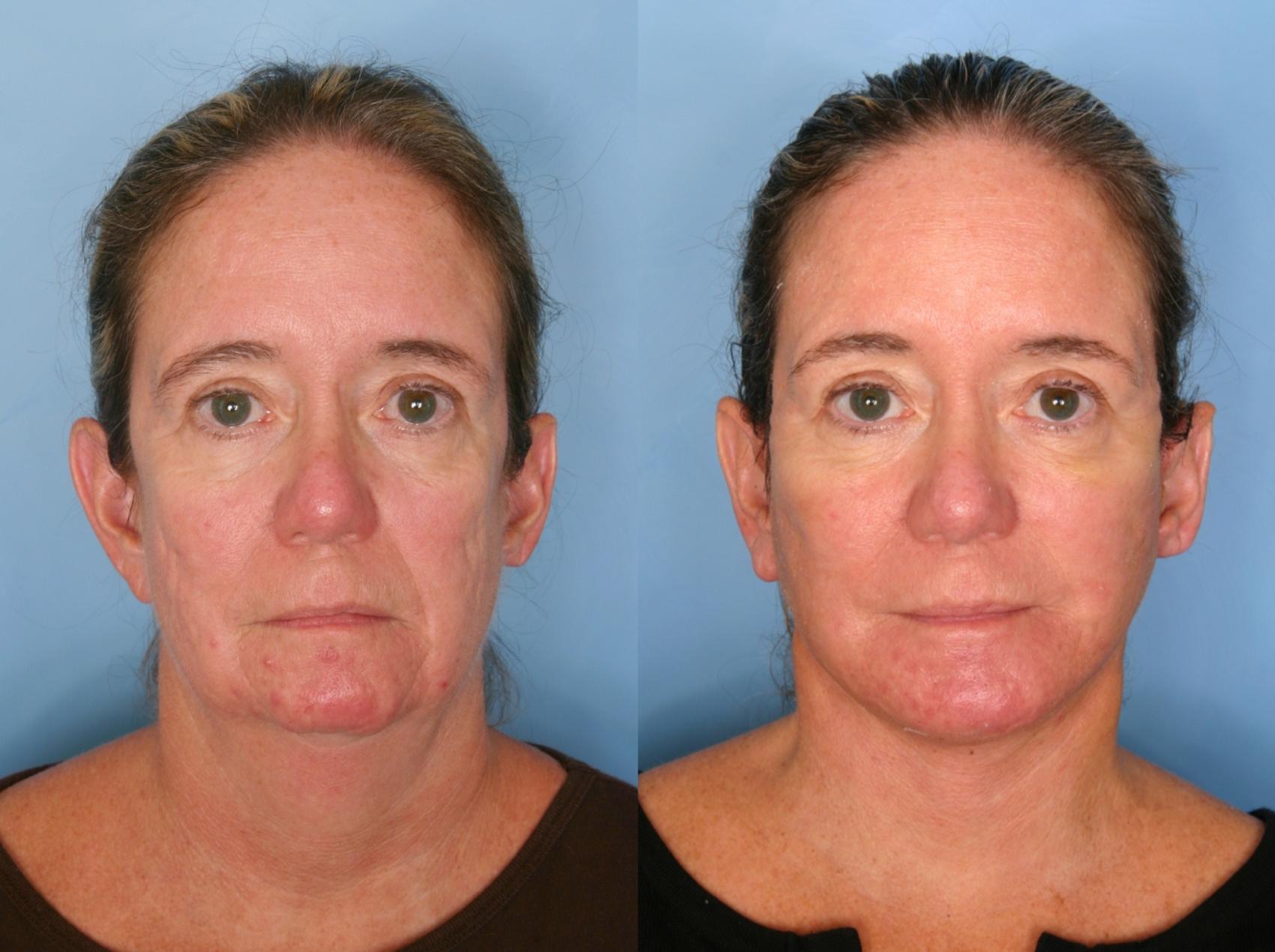 Before & After Facelift Case 66 View #2 View in Naples and Ft. Myers, FL