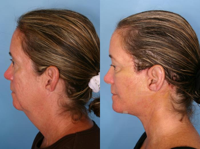 Before & After Facelift Case 66 View #3 View in Naples and Ft. Myers, FL