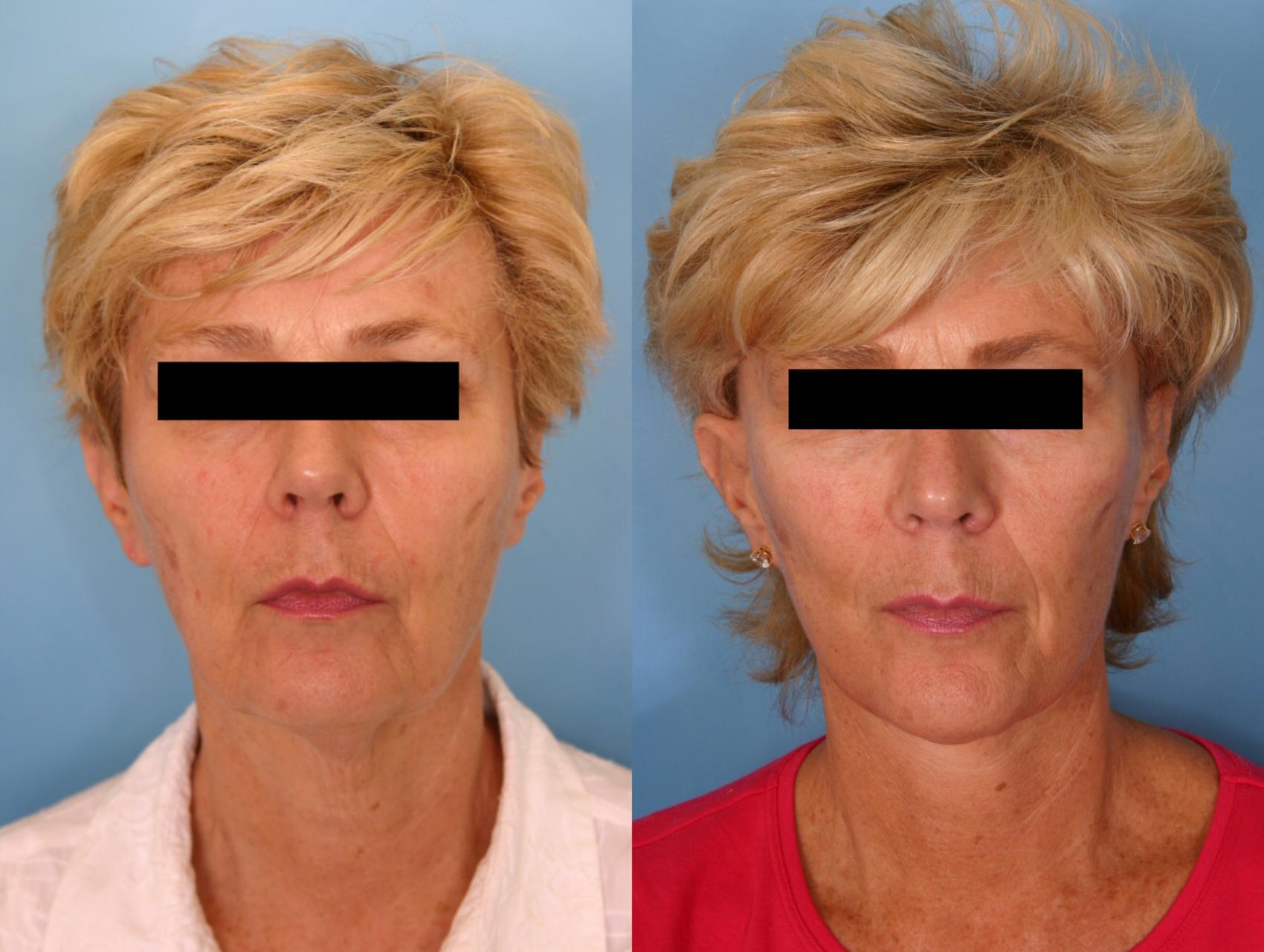 Before & After Facelift Case 8 View #3 View in Naples, FL