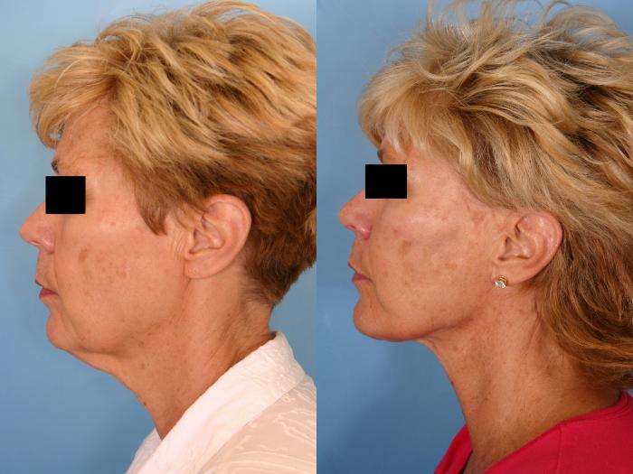 Before & After Facelift Case 8 View #4 View in Naples and Ft. Myers, FL