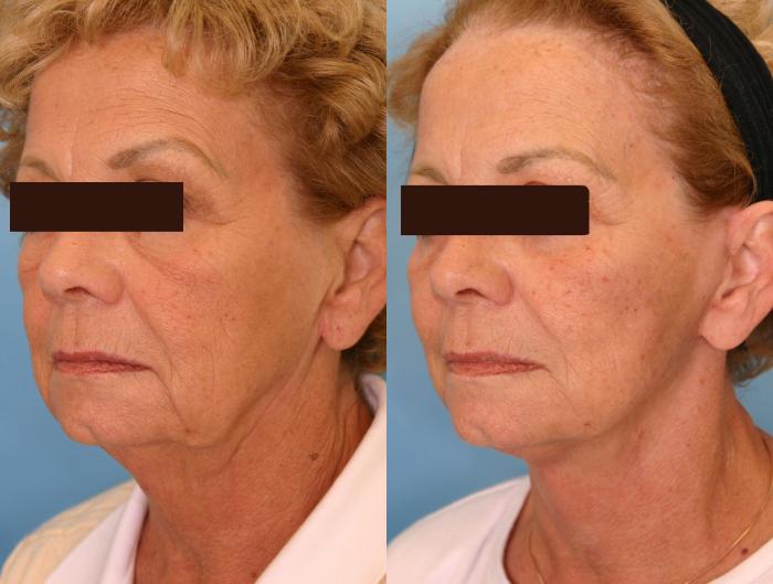 Before & After Facelift Case 9 View #3 View in Naples and Ft. Myers, FL