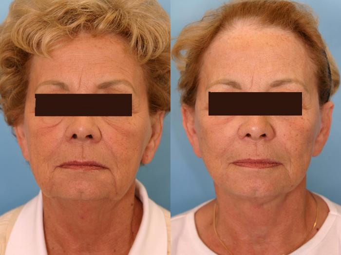 Before & After Facelift Case 9 View #4 View in Naples and Ft. Myers, FL