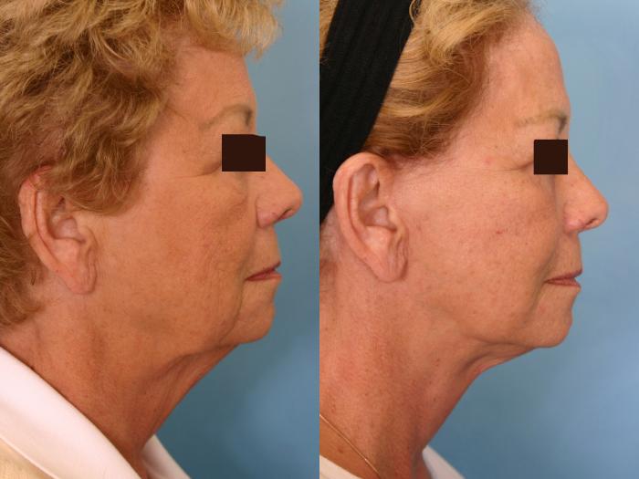Before & After Facelift Case 9 View #5 View in Naples and Ft. Myers, FL