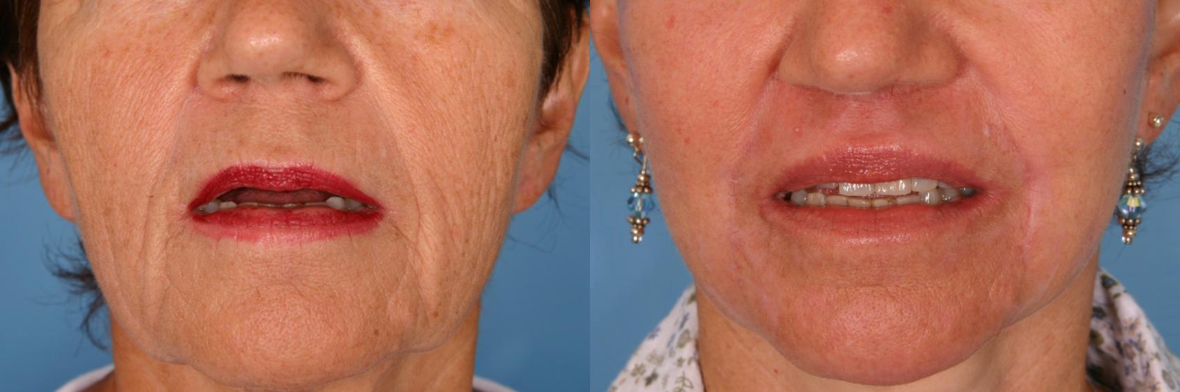 Before & After Fat Injections Case 24 View #1 View in Naples and Ft. Myers, FL