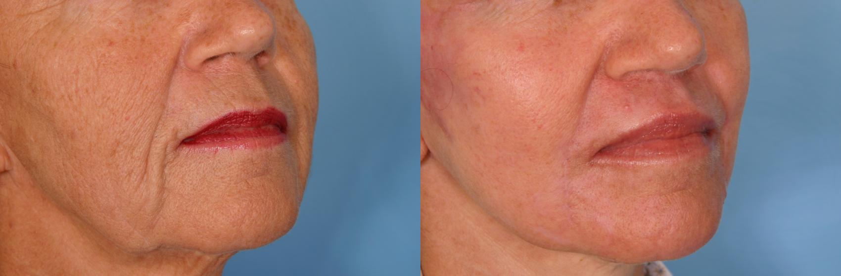 Before & After Fat Injections Case 24 View #2 View in Naples and Ft. Myers, FL