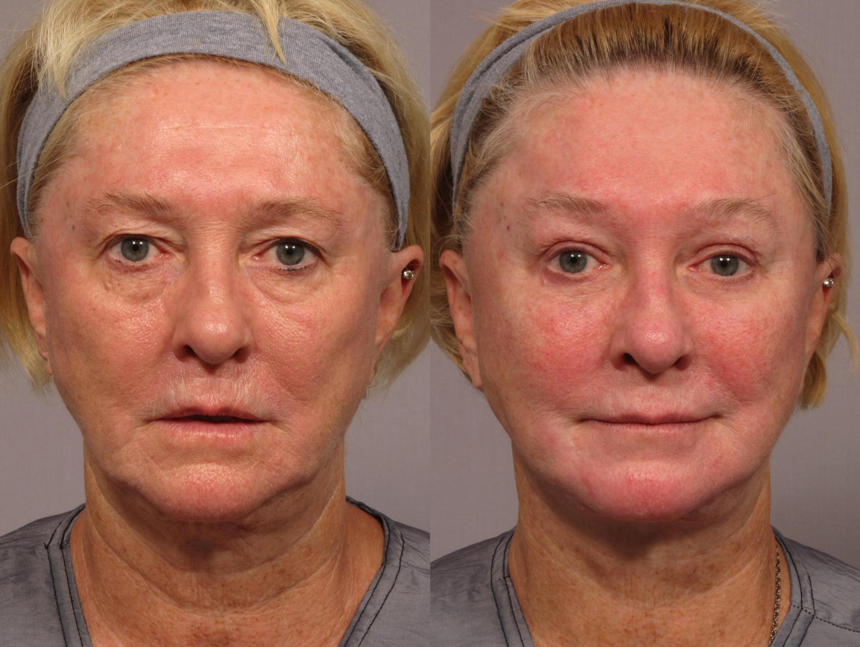 Before & After Fat Injections Case 299 View #1 View in Naples and Ft. Myers, FL