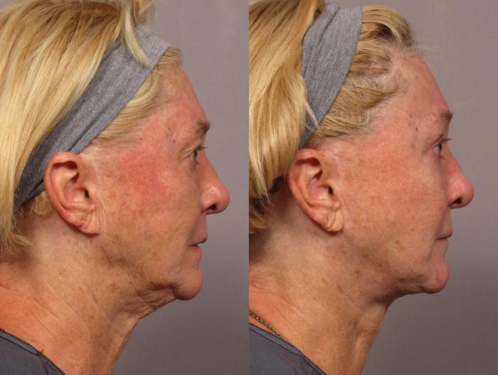 Before & After Fat Injections Case 299 View #2 View in Naples and Ft. Myers, FL