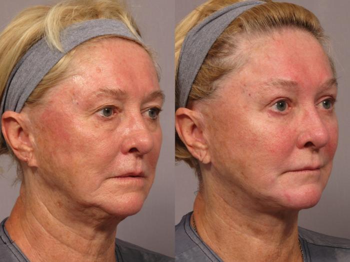 Before & After Fat Injections Case 299 View #3 View in Naples and Ft. Myers, FL