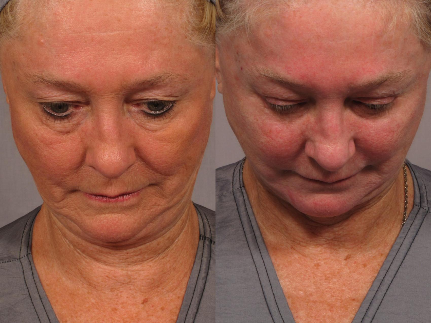 Before & After Fat Injections Case 299 View #4 View in Naples and Ft. Myers, FL
