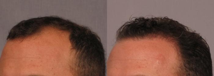 Before & After FUE Results Achieved with SmartGraft or Neograft Case 298 View #2 View in Naples and Ft. Myers, FL