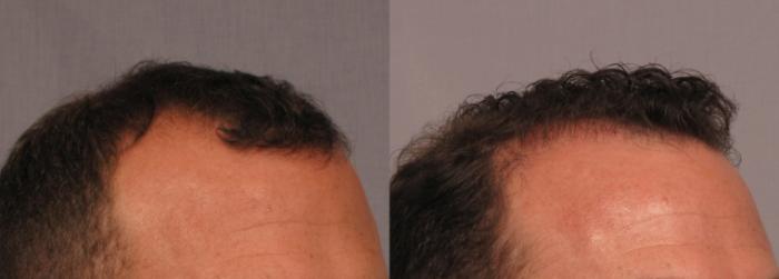 Before & After FUE Results Achieved with SmartGraft or Neograft Case 298 View #3 View in Naples and Ft. Myers, FL