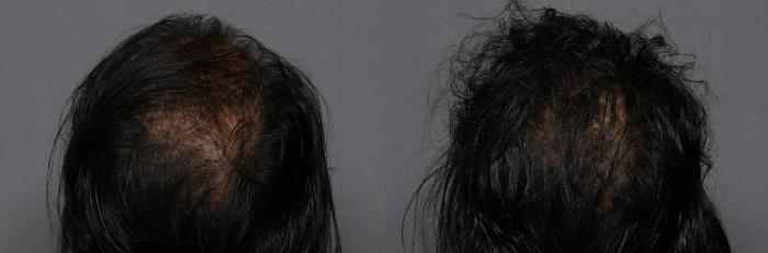 SmartGraft, Back View, Naples Florida, Kent V. Hasen Aesthetic Plastic Surgery & Med Spa of Naples
