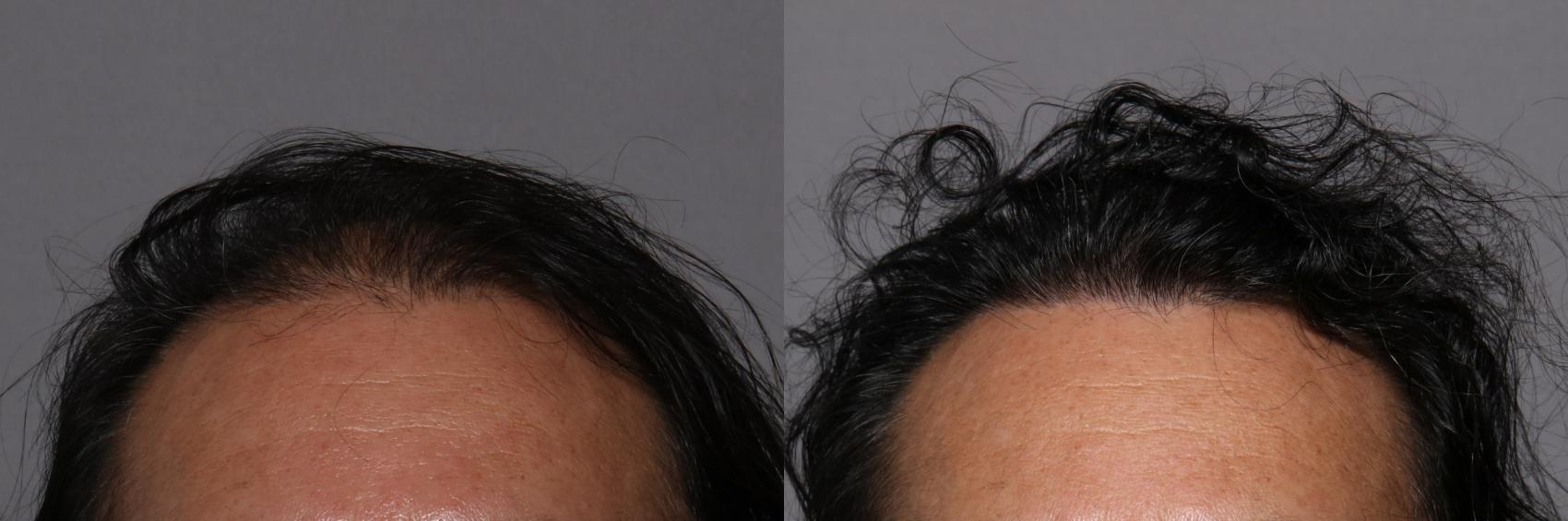 SmartGraft, Frontal View, Naples Florida, Kent V. Hasen Aesthetic Plastic Surgery & Med Spa of Naples