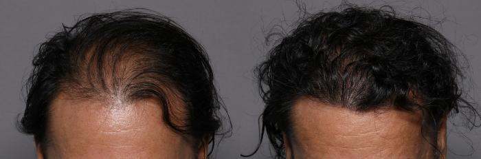 SmartGraft, Frontal Down View, Naples Florida, Kent V. Hasen Aesthetic Plastic Surgery & Med Spa of Naples