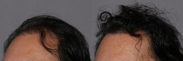 SmartGraft, Left Oblique View, Naples Florida, Kent V. Hasen Aesthetic Plastic Surgery & Med Spa of Naples