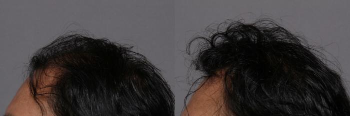 SmartGraft, Left Side View, Naples Florida, Kent V. Hasen Aesthetic Plastic Surgery & Med Spa of Naples