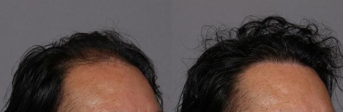 SmartGraft, Right Oblique View, Naples Florida, Kent V. Hasen Aesthetic Plastic Surgery & Med Spa of Naples