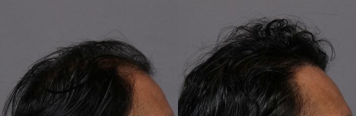 SmartGraft, Right Side View, Naples Florida, Kent V. Hasen Aesthetic Plastic Surgery & Med Spa of Naples