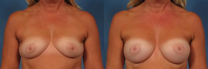 Before & After Gummy Bear Cohesive Gel Implants Case 232 View #1 View in Naples and Ft. Myers, FL