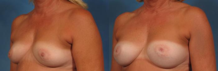 Before & After Gummy Bear Cohesive Gel Implants Case 232 View #8 View in Naples and Ft. Myers, FL