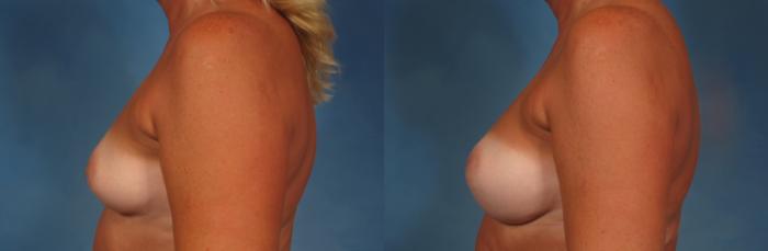 Before & After Gummy Bear Cohesive Gel Implants Case 232 View #9 View in Naples and Ft. Myers, FL