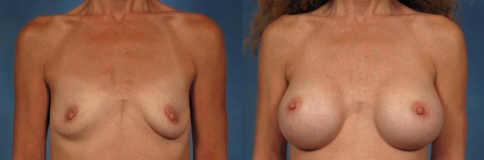 Before & After Gummy Bear Cohesive Gel Implants Case 254 View #1 View in Naples and Ft. Myers, FL