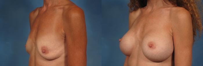 Before & After Gummy Bear Cohesive Gel Implants Case 254 View #2 View in Naples and Ft. Myers, FL