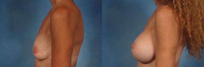 Before & After Gummy Bear Cohesive Gel Implants Case 254 View #3 View in Naples and Ft. Myers, FL