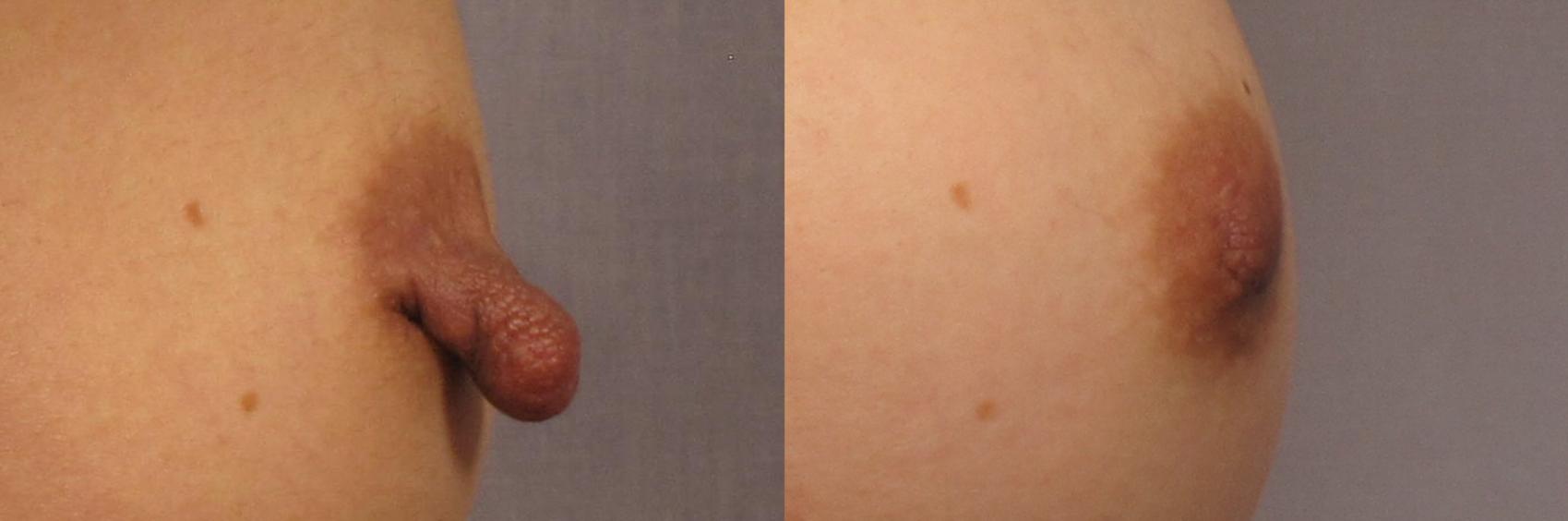 Gummy Bear Cohesive Gel Implants Before and After Pictures Case