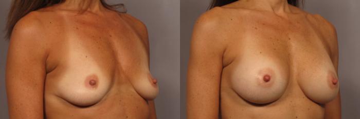 Before & After Gummy Bear Cohesive Gel Implants Case 323 View #2 View in Naples and Ft. Myers, FL