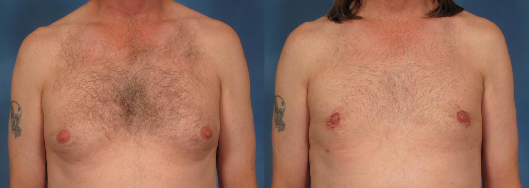 Before & After Gynecomastia Case 178 View #1 View in Naples and Ft. Myers, FL