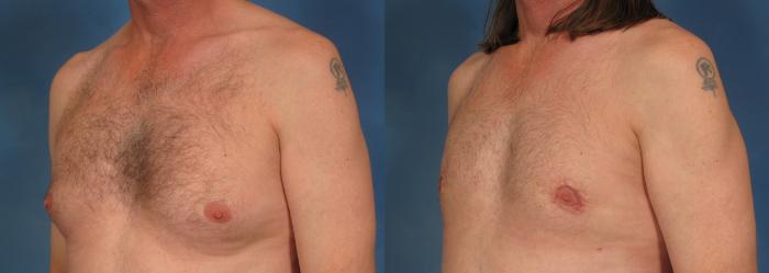 Before & After Gynecomastia Case 178 View #3 View in Naples and Ft. Myers, FL