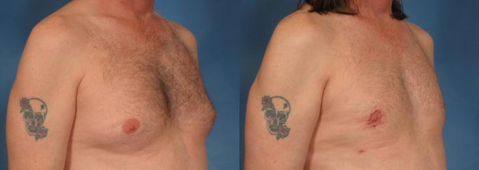Before & After Gynecomastia Case 178 View #4 View in Naples and Ft. Myers, FL