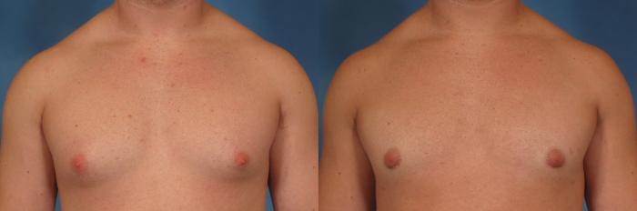 Before & After Gynecomastia Case 191 View #1 View in Naples and Ft. Myers, FL