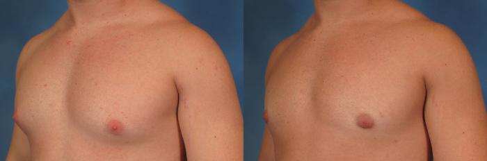 Before & After Gynecomastia Case 191 View #2 View in Naples and Ft. Myers, FL