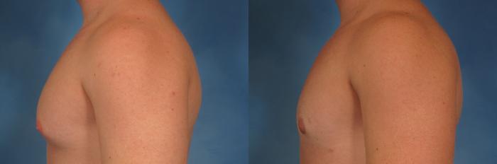 Before & After Gynecomastia Case 191 View #3 View in Naples and Ft. Myers, FL