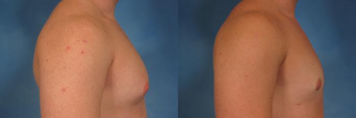 Before & After Gynecomastia Case 191 View #5 View in Naples and Ft. Myers, FL